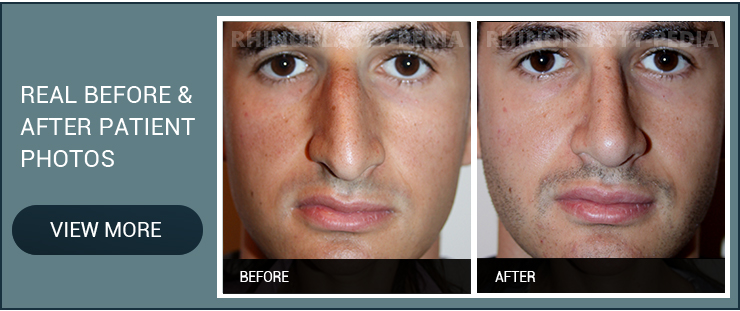 rhinoplasty for a broken nose real before and after male patient photo