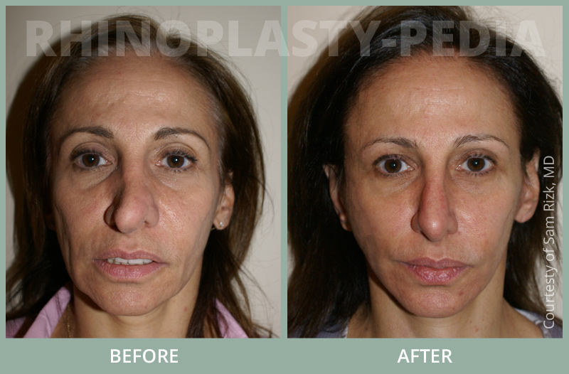 rhinoplasty female patient before and after photo 23