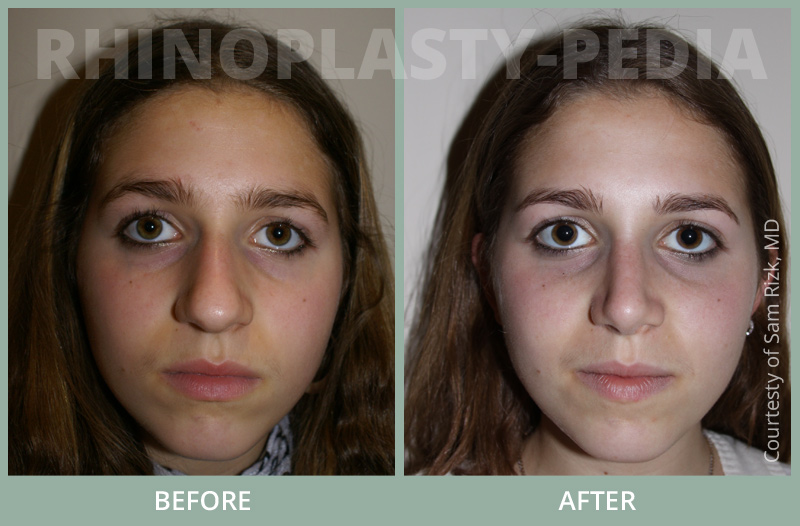 rhinoplasty female patient before and after photo set 66