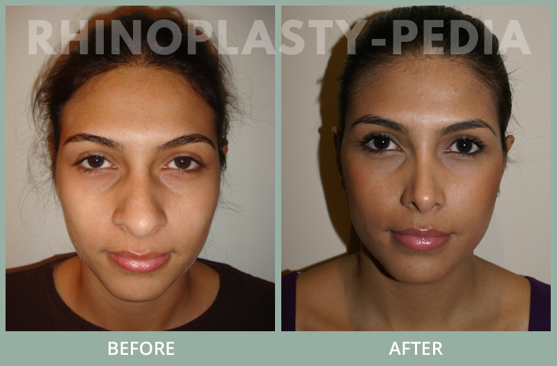 rhinoplasty female patient before and after photo set 19