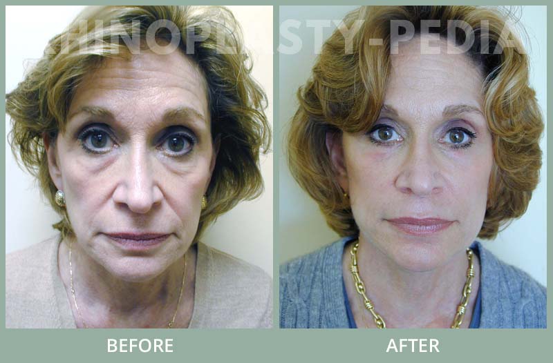 female rhinoplasty patient before and after photo 11