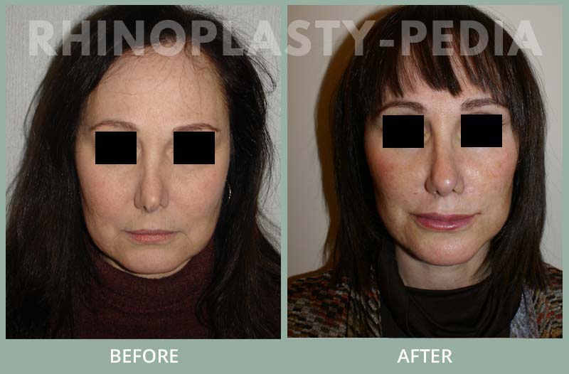 rhinoplasty female patient before and after photo set 82