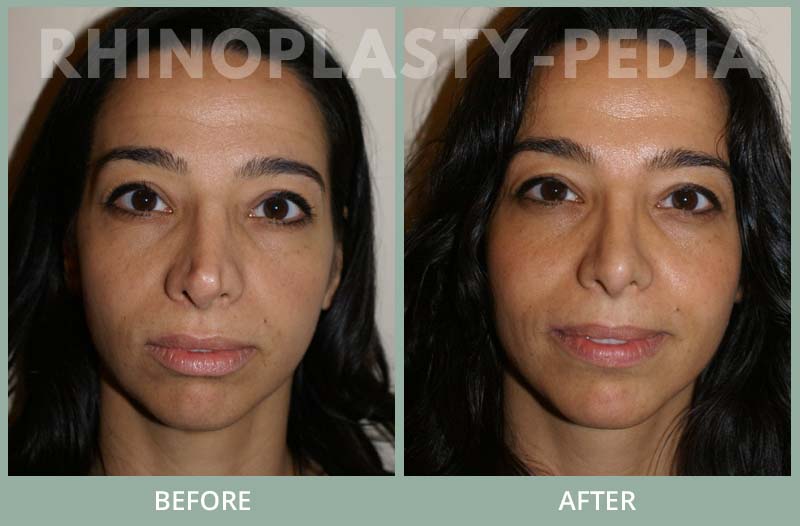 rhinoplasty female patient before and after photo 37