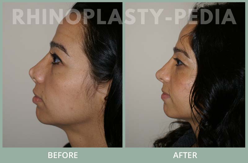 rhinoplasty female patient before and after photo set 85