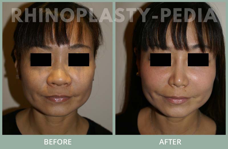rhinoplasty female patient before and after photo 38