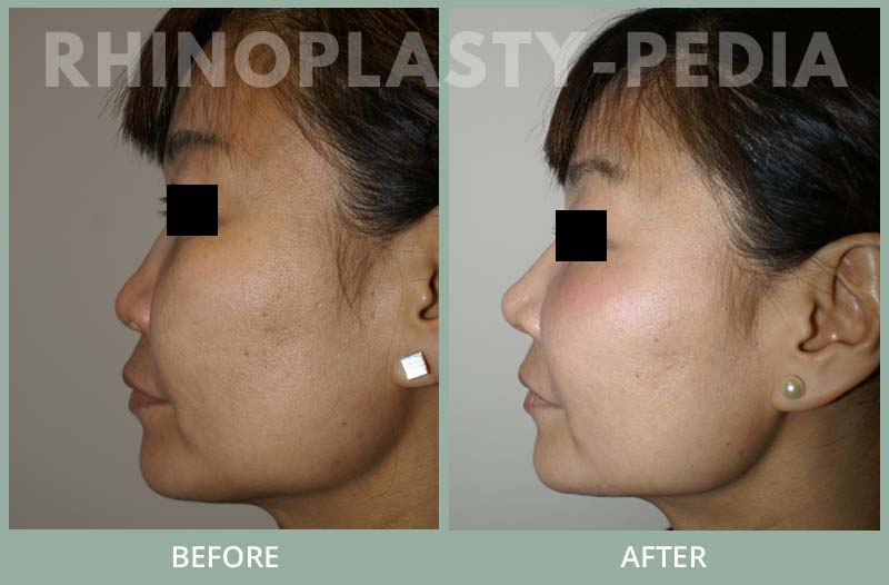 rhinoplasty female patient before and after photo set 86