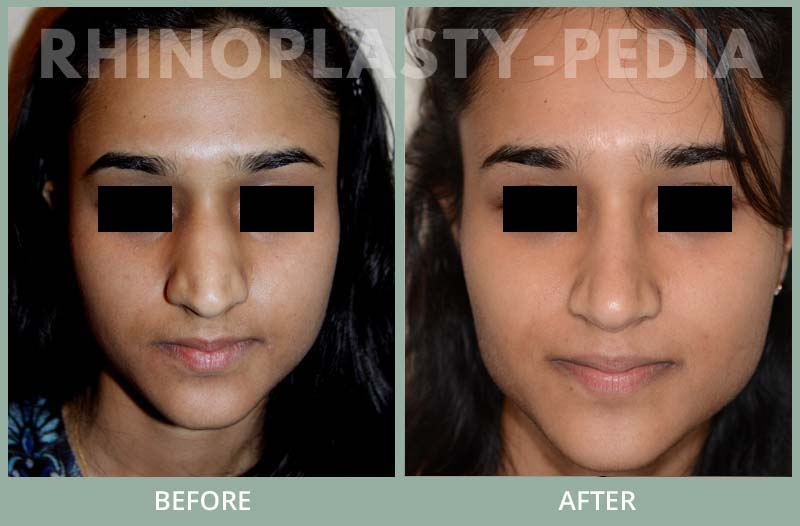 female rhinoplasty patient before and after photo 24