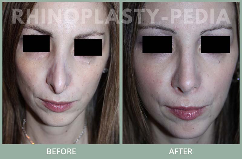 rhinoplasty female patient before and after photo set 89