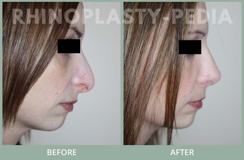 rhinoplasty female patient before and after photo set 90