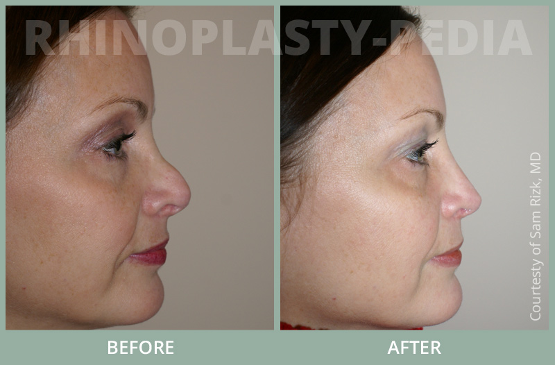 rhinoplasty female patient before and after photo set 65