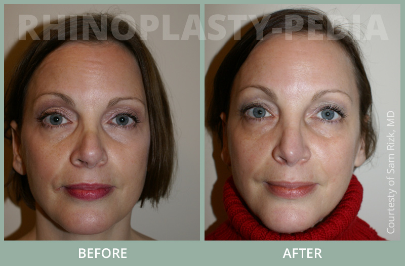 rhinoplasty female patient before and after photo set 66