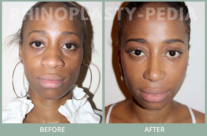 female rhinoplasty patient before and after photo 28