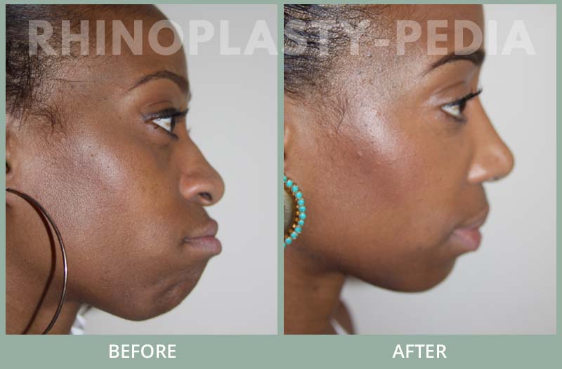 rhinoplasty female patient before and after photo set 93