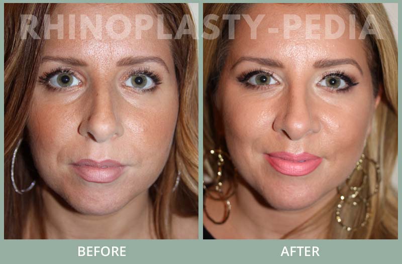 rhinoplasty female patient before and after photo set 94
