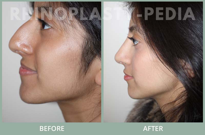 female rhinoplasty patient before and after photo 32