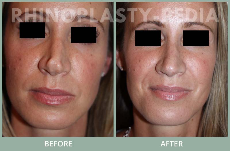rhinoplasty female patient before and after photo 51