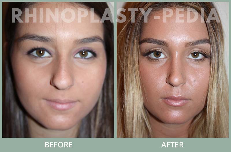 rhinoplasty female patient before and after photo set 100