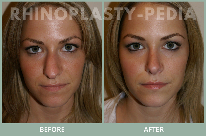 rhinoplasty female patient before and after thumb photo 33