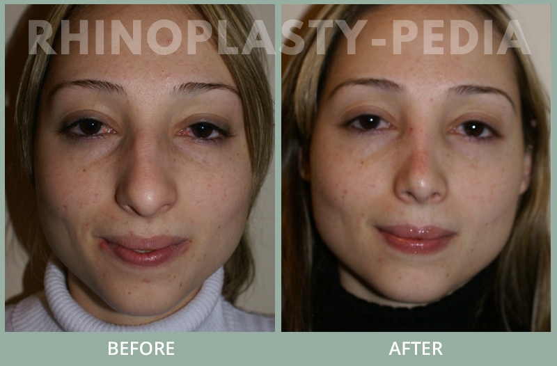 rhinoplasty female patient before and after photo set 103