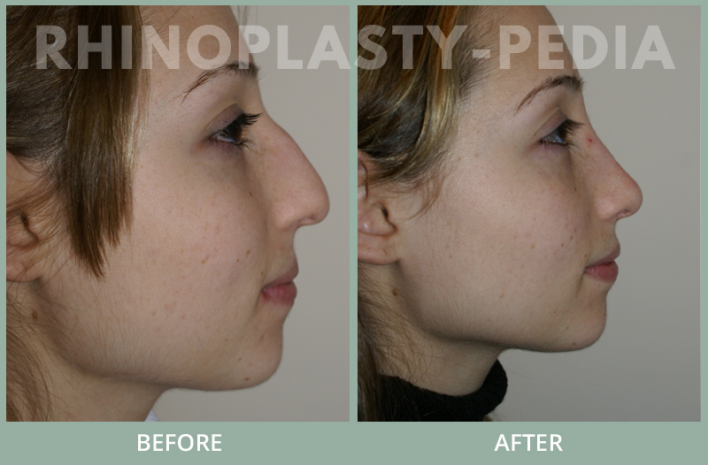 rhinoplasty female patient before and after photo set 104