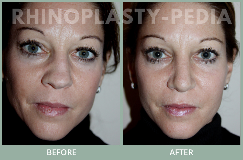 rhinoplasty female patient before and after photo 41