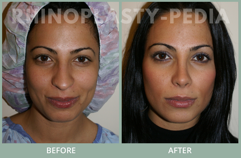 rhinoplasty female patient before and after photo set 109