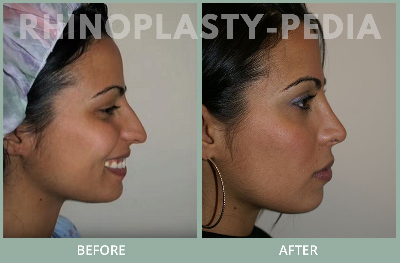 rhinoplasty female patient before and after photo set 110
