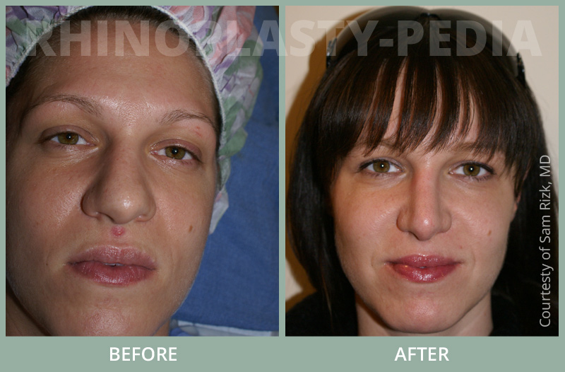 rhinoplasty female patient before and after thumb photo set 63