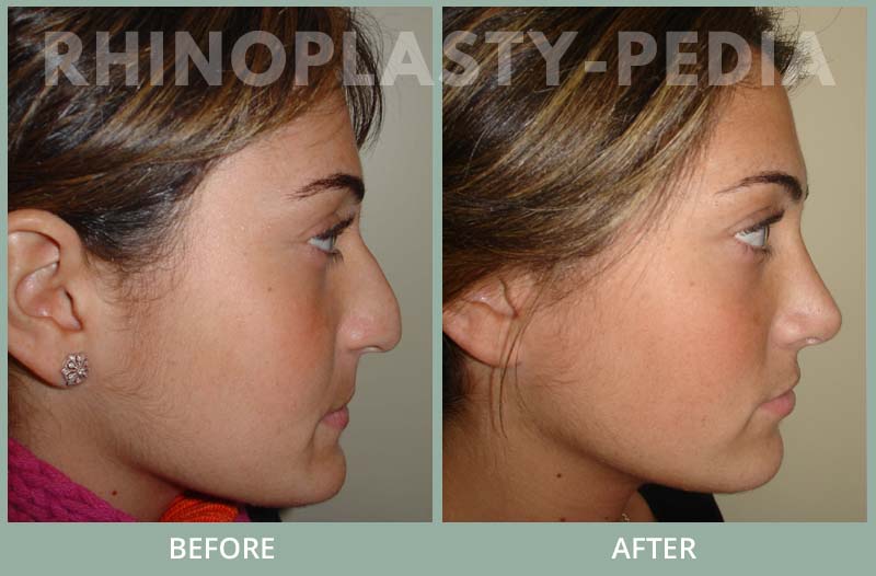 rhinoplasty female patient before and after photo 28