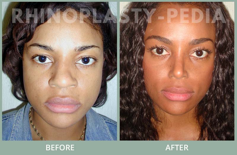 rhinoplasty female patient before and after photo 29