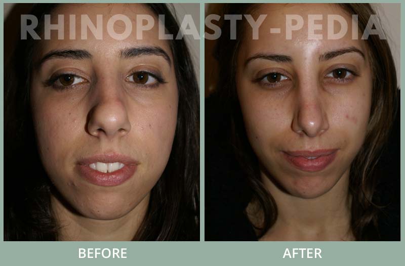 rhinoplasty female patient before and after photo 36
