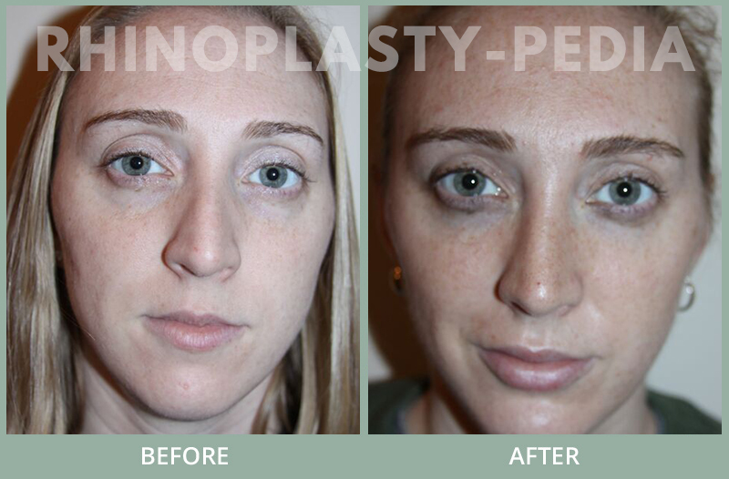 rhinoplasty female patient before and after photo set 119