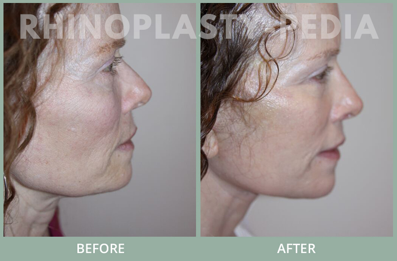rhinoplasty female patient before and after photo set 122