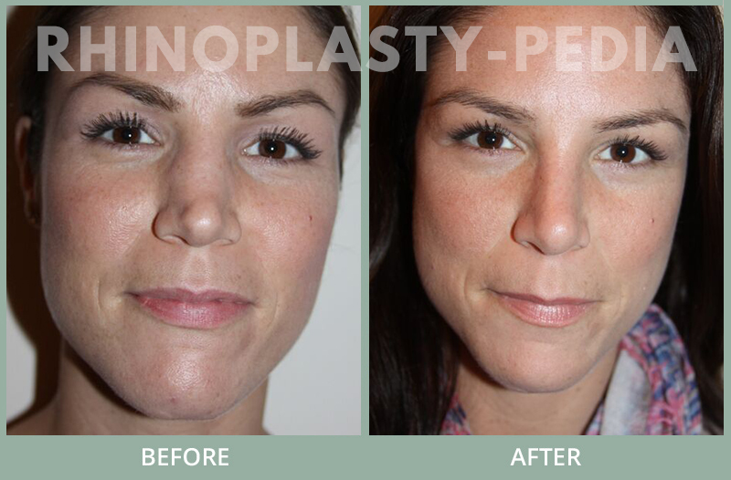 female rhinoplasty patient before and after photo 38