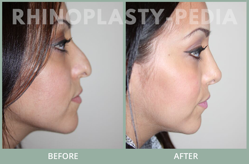female rhinoplasty patient before and after photo 39
