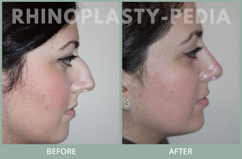 rhinoplasty female patient before and after photo set 127