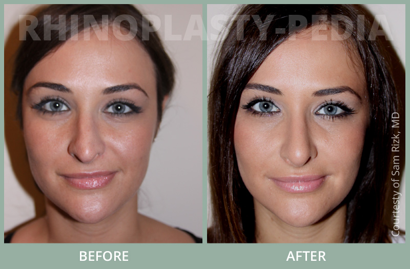 rhinoplasty female patient before and after photo set 62