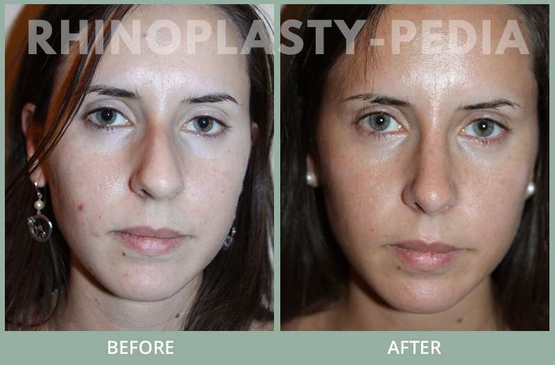rhinoplasty female patient before and after photo set 128
