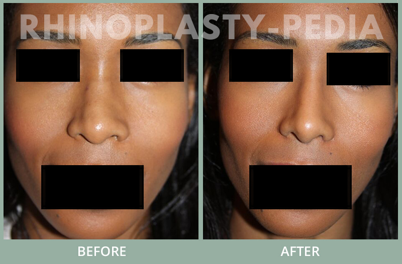 rhinoplasty female patient before and after photo set 75