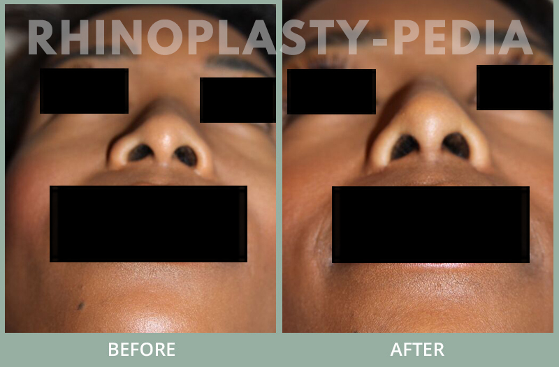 rhinoplasty female patient before and after photo set 77
