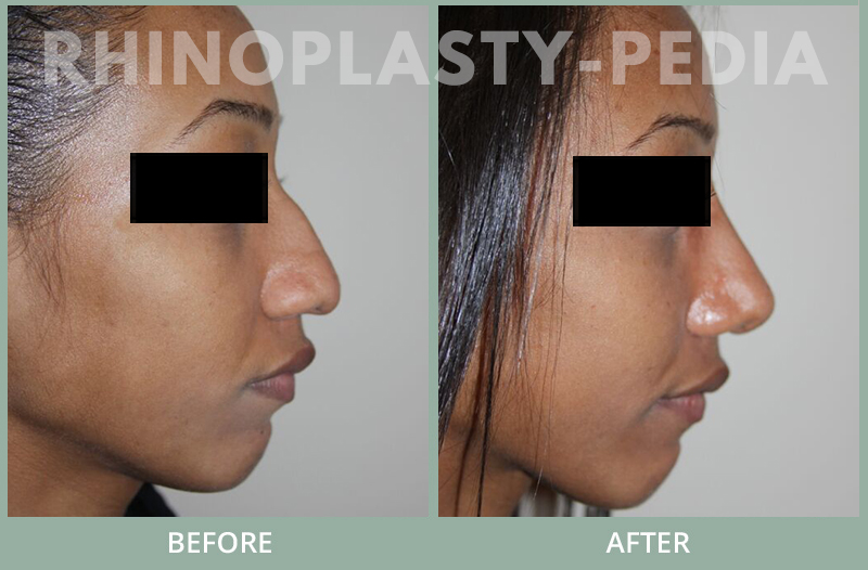rhinoplasty female patient before and after photo set 74