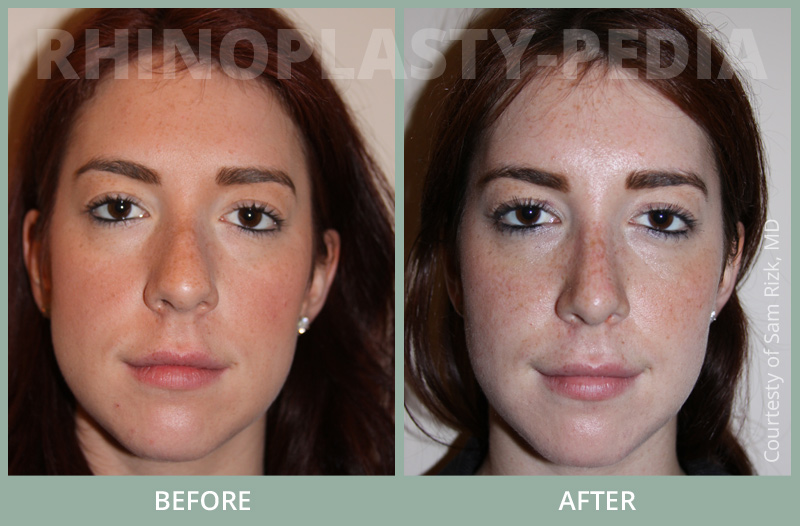 rhinoplasty female patient before and after photo set 60
