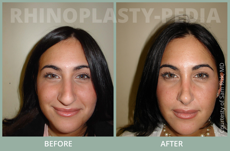 rhinoplasty female patient before and after photo 26