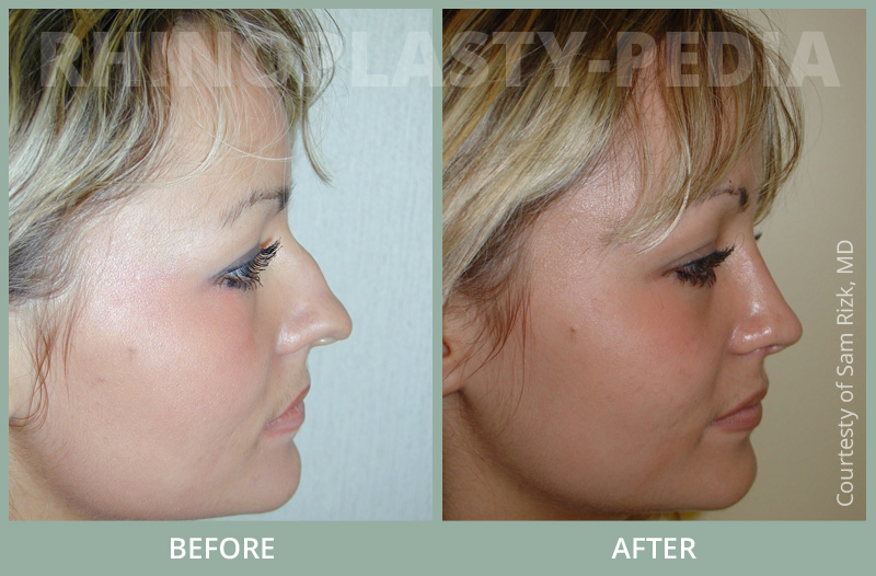 female rhinoplasty patient before and after photo set 17