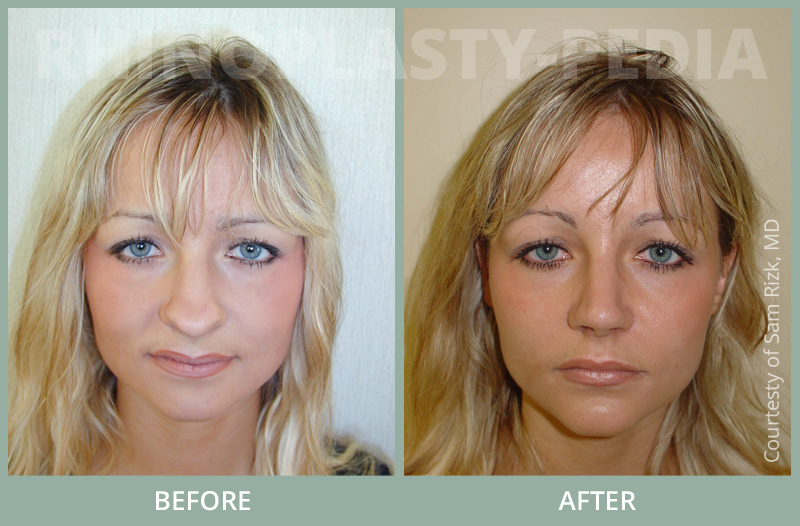 rhinoplasty female patient before and after photo 39
