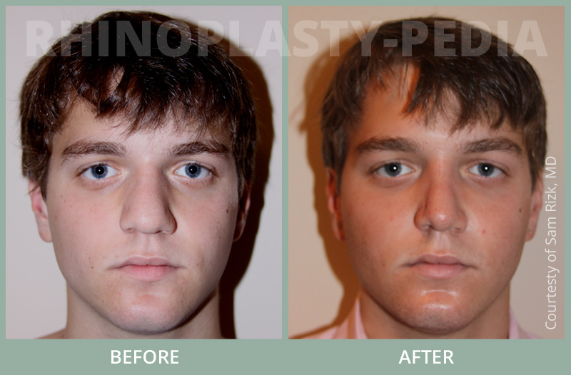 rhinoplasty male patient before and after photo set 12