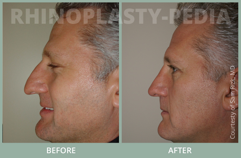 rhinoplasty male patient before and after photo set 31