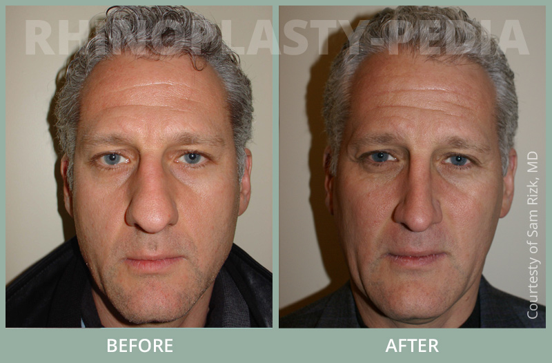 rhinoplasty male patient before and after photo set 32