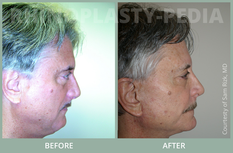 male rhinoplasty patient before and after photo 6