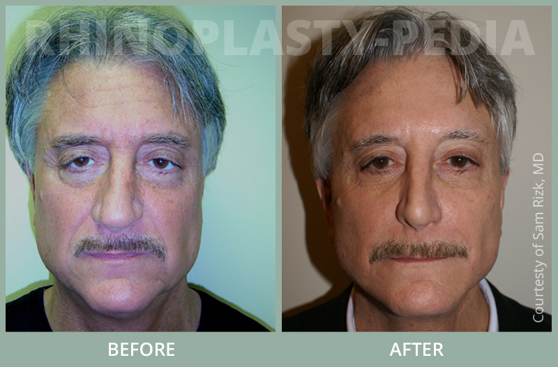 rhinoplasty male patient before and after photo set 31